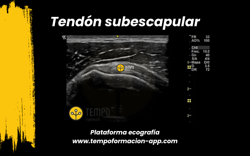 12. Ecografia tempo formacion manguito rotador tendon supraespinoso infraespinoso redondo menor subescapular.png